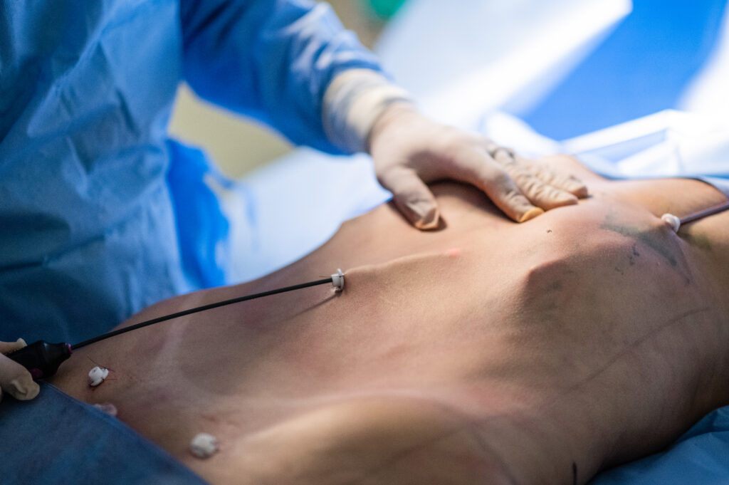LIPOASPIRACAO-CLINICA-BINDER-DIVINOPOLIS